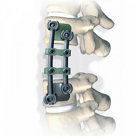Stryker XIA anterior